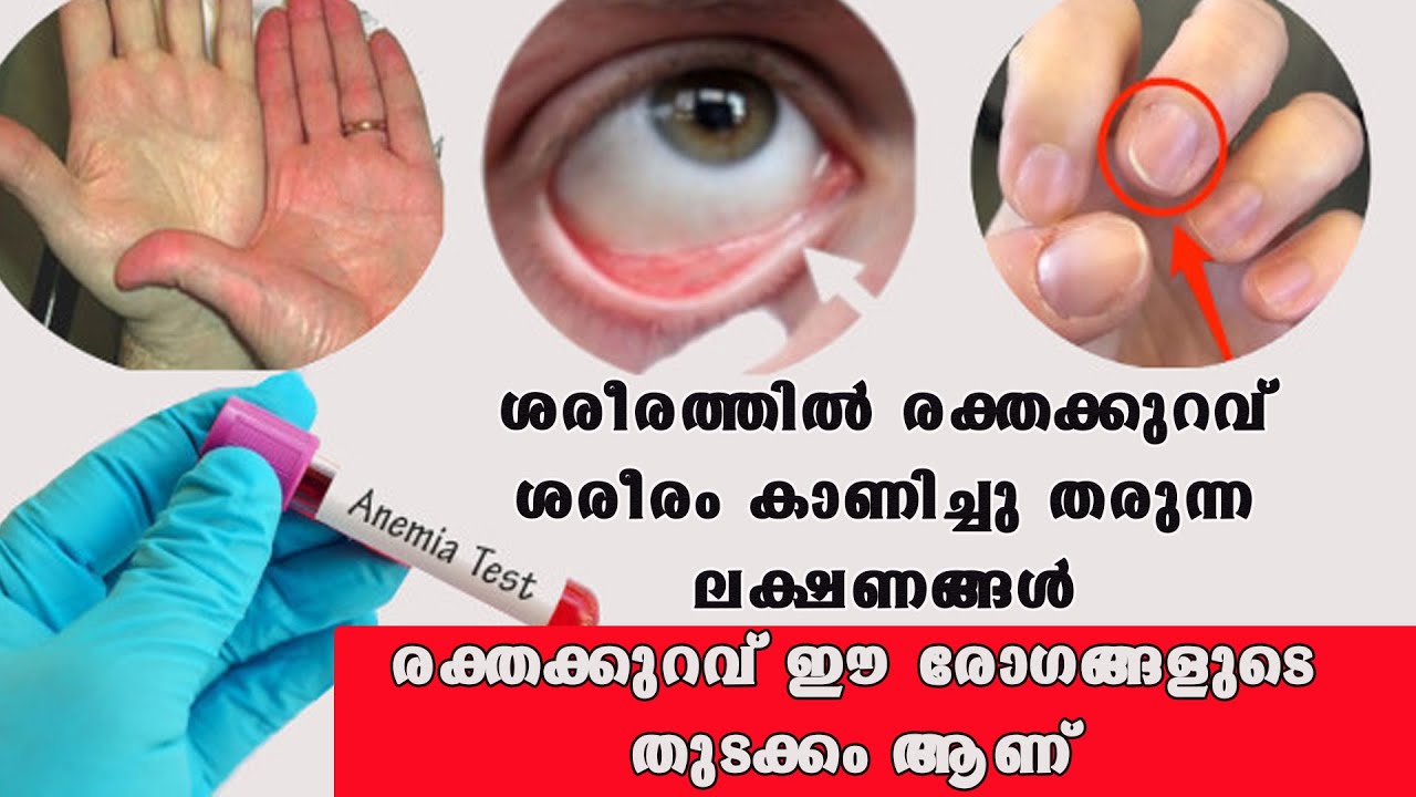 ശരീരത്തിലെ രക്തക്കുറവ് ഈ സത്യങ്ങള്‍ അറിയാതെ  പോകരുത് /Baiju's Vlogs