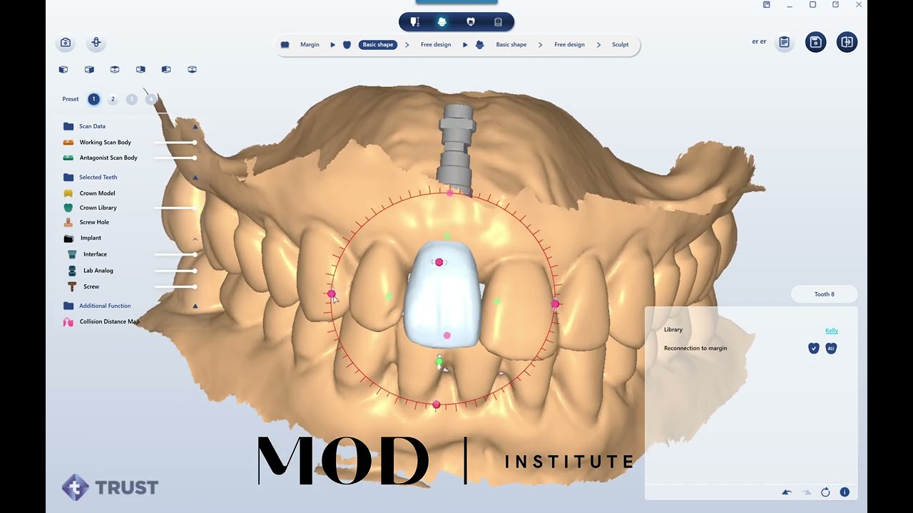 How to get perfect occlusion on your restorations - YouTube