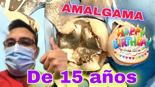 SE FR4CTURA UN MOLAR con AMALGAMA DE 15 AÑOS [asi reconstruimos en 4 meses] by ESPECIALIDADES ODONTOLOGICAS 12,606 views 3 years ago 8 minutes, 37 seconds