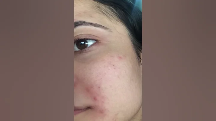 best treatment for fungal acne ❤️how to clear fungal acne #viral #skincare #shorts