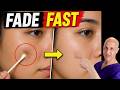 Do This to Remove Hyperpigmentation FAST