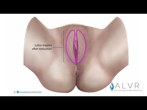 Labia Majora Reduction Animation - Underside View