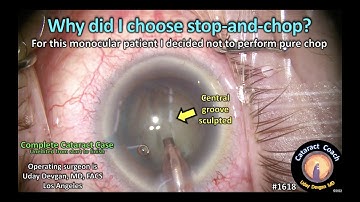 CataractCoach 1618: Why did I choose stop and chop instead of phaco chop?