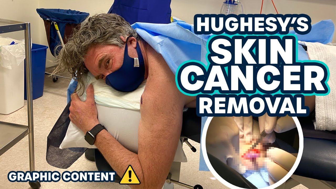 Hughesy's Skin Cancer Removal | Hughesy & Ed