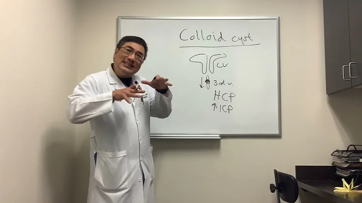 Colloid cysts