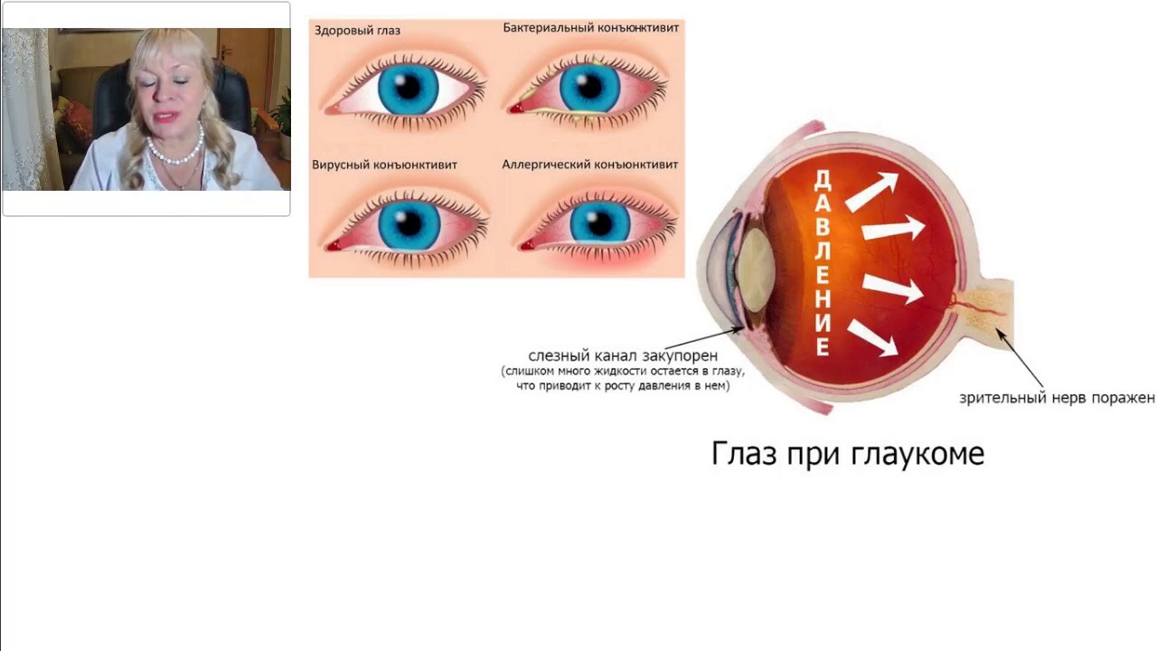 Что нельзя делать при глаукоме. Катаракта, глаукома, дальнозоркость и близорукость это что это такое-. Зрение при глаукоме. Катаракта близорукость.
