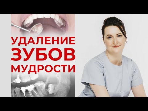 Удаление зуба мудрости / Интервью со стоматологом-хирургом