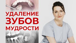 Удаление зуба мудрости / Интервью со стоматологом-хирургом