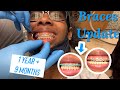 My Last Braces Update 😫 | Final Appointment | braces App