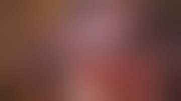 VATS biport segmentectomy Lingula