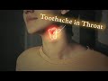 Hyoidynia | A Toothache in the Neck