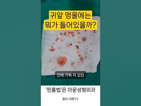 귀앞 멍울 뭐가 들어있나? (표피낭종 피지낭종 핀홀법 수술 성형외과 병원 Epidermal Epidermoid Cyst ...