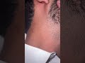 #hairstyle #hairgrowth #asmr#ingrownhairremoval #removeingrown #satisfying #oddlysatisfying