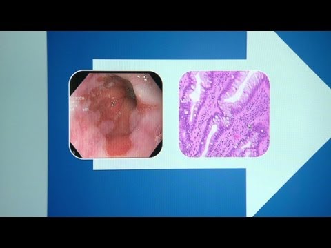 Video: Esofagita poate provoca cancer?