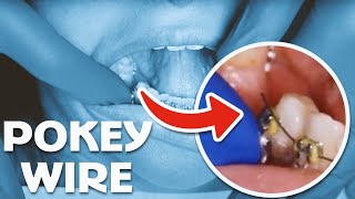 How to Cut Pokey Braces Wire at Home (Video)