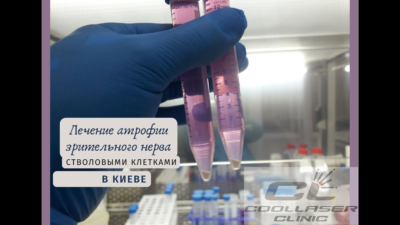 Атрофия зрительного нерва: как лечат заболевание стволовыми клетками ...