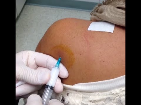 Steroid injection shoulder tendonitis