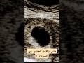 متى يظهر الجنين في السونار 