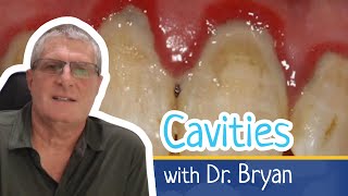 Sugar and Cavities - What is the relationship between the two?
