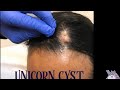 Unicorn cyst scalp cyst incision and drainage