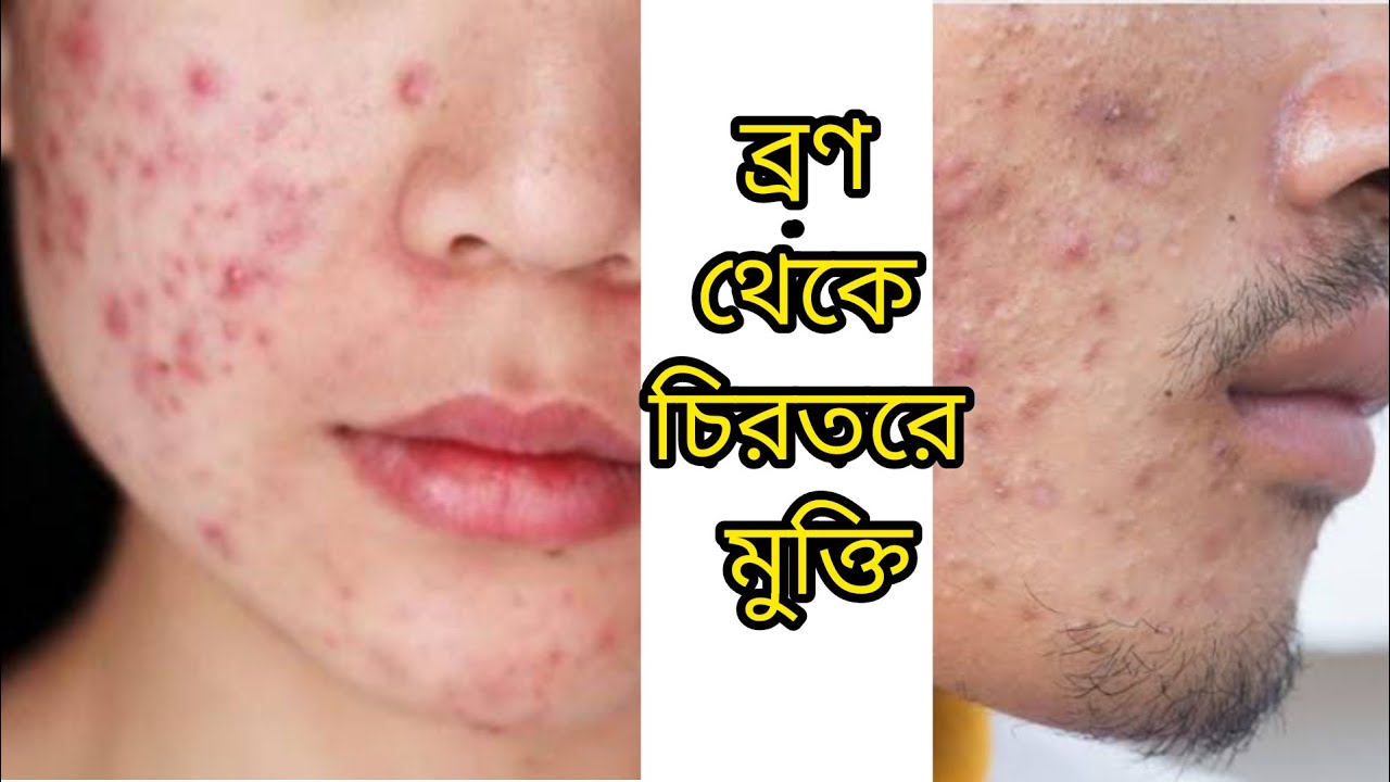 Reetigel Retigel Cream | ব্রণ দূর করার উপায় |ব্রণ দূর করার কার্যকরি ক্রিম ...