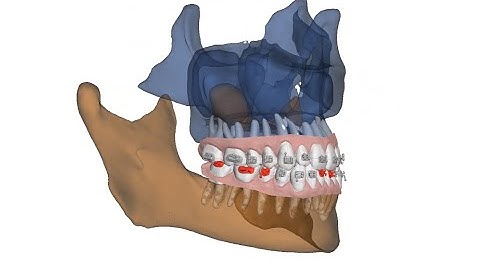 Pivot point for better bite turbos
