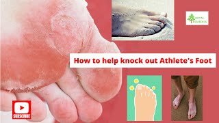 How to help knock out Athlete's Foot | Home Remedies For Athletes Foot