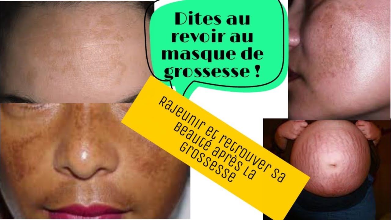 Fini le masque de grossesse avec ce mélange ! Anti rides, masque