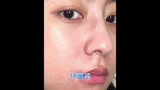 울긋불긋 붉게 올라온 홍조