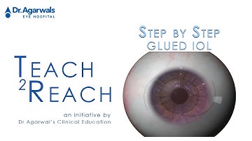 Step by Step for Glued IOL