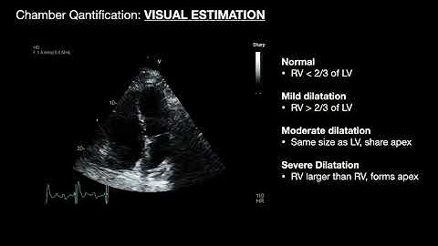 Right ventricle: Anatomy and Chamber Quantification