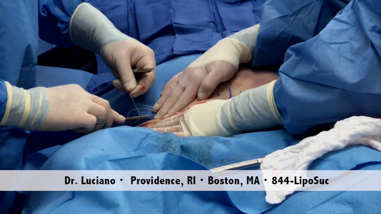 Mini Tummy Tuck Awake By Dr. Luciano YouTube