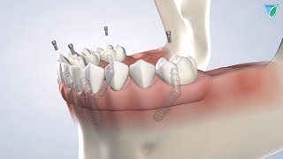 Full-Arch Restoration at Upstate Oral Surgery Dental Implants Watertown NY