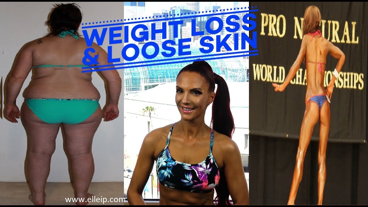 Weight Loss Loose Skin And Surgery YouTube