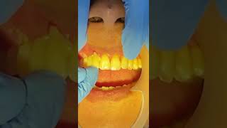 Cantilever Bridge (dental bridge)