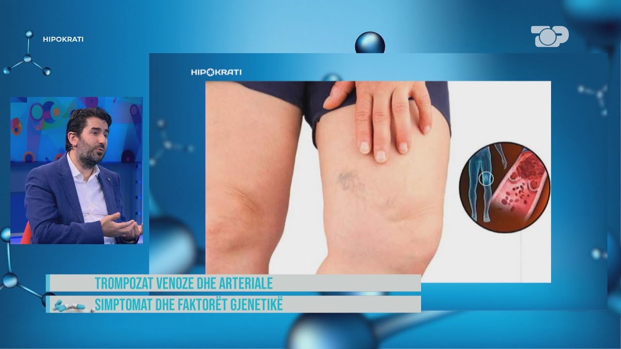 Maviosje në këmbë? Këto janë disa nga shenjat e trompozës! - Hipokrati