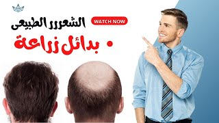 بدائل زراعة الشعر الطبيعي