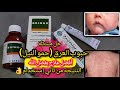 علاج حبوب العرق الحمونيل في يومين الحل السحري لمشاكل الجلد في الصيف للأطفال تجربتي الشخصيه مع إبني 