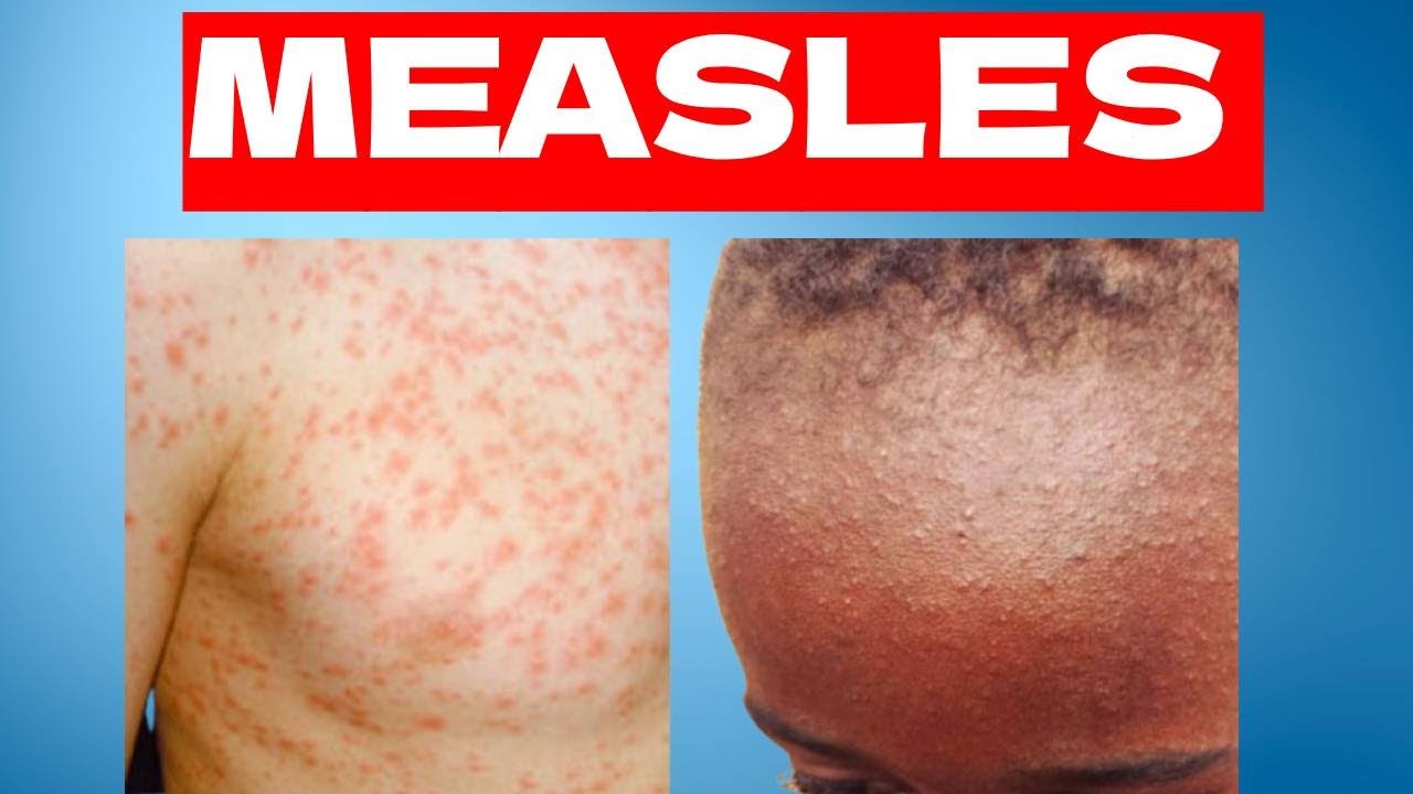 Measles | Signs and Symptoms Treatment and Prevention of Measles in Children and Adults
