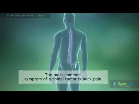 Spinal Tumor Symptoms