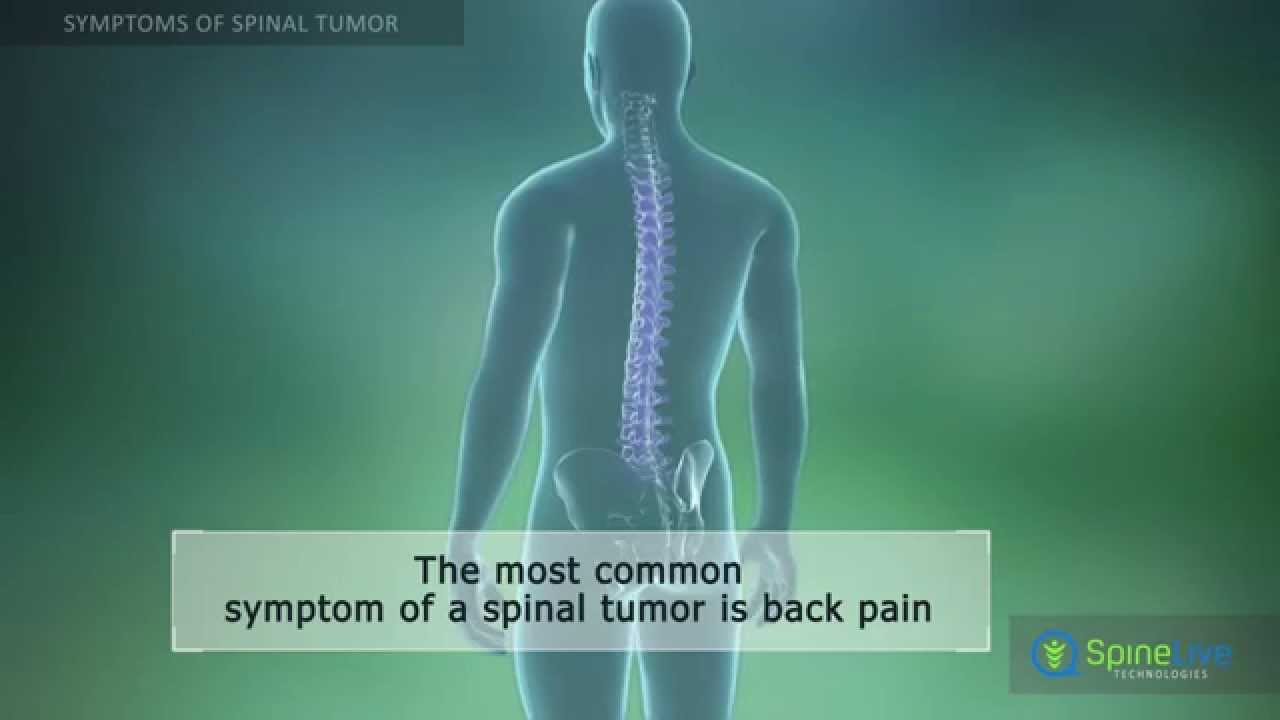 Spinal tumor - Pictures