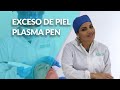 Exceso de piel - Plasma Pen