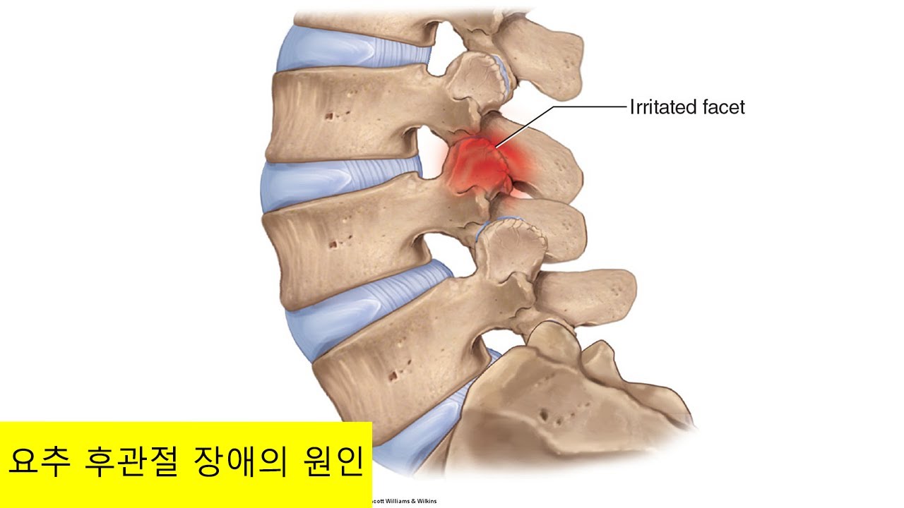 요추 후관절 장애의 원인 - YouTube
