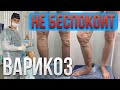 Варикоз не беспокоит, нужно ли лечить?