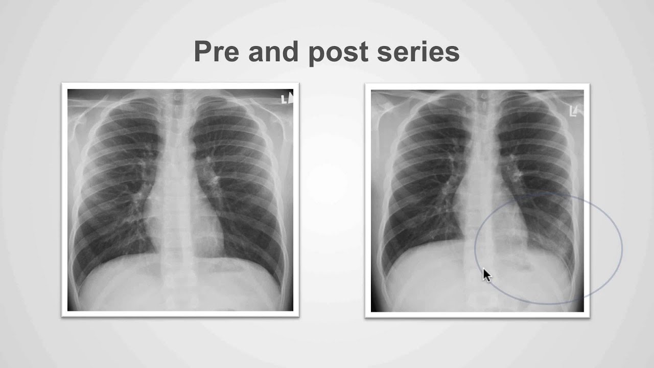 Getting into the chest X-ray: How pathology changes the greyscale (part