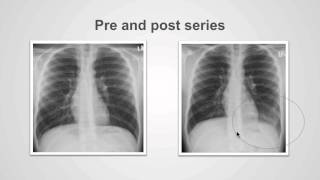 Getting into the chest X-ray: How pathology changes the greyscale (part 4)