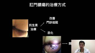 肛門膿瘍與廔管的治療--許詔文醫師 treatment for perianal abscess & fistula, ChaoWen Hsu, MD