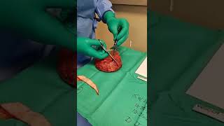 Dr. Khan Removes Silicone Gummy Bear Implants From 63 Year Old Patient with a Silent Rupture.