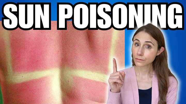 How To Know If You Have Sun Poisoning