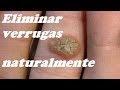 TRES REMEDIOS PARA ELIMINAR VERRUGAS. Three remedies to eliminate warts.